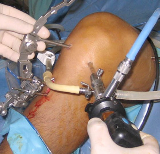 arthroskopische_knieoperation