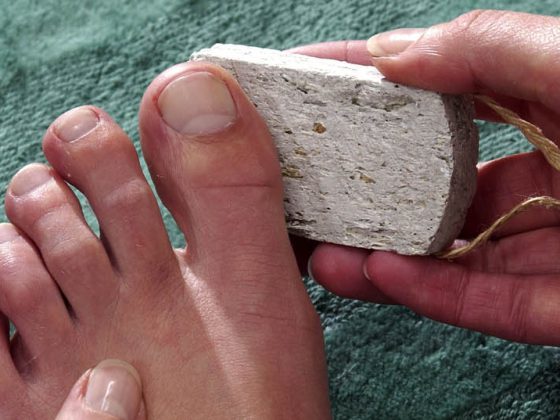 fuss_fusspflege_diabetes_hornhaut