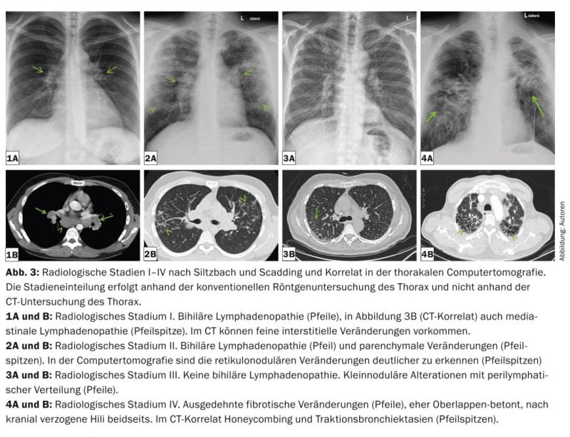 Diagnóstico y terapia de la sarcoidosis - Medizinonline