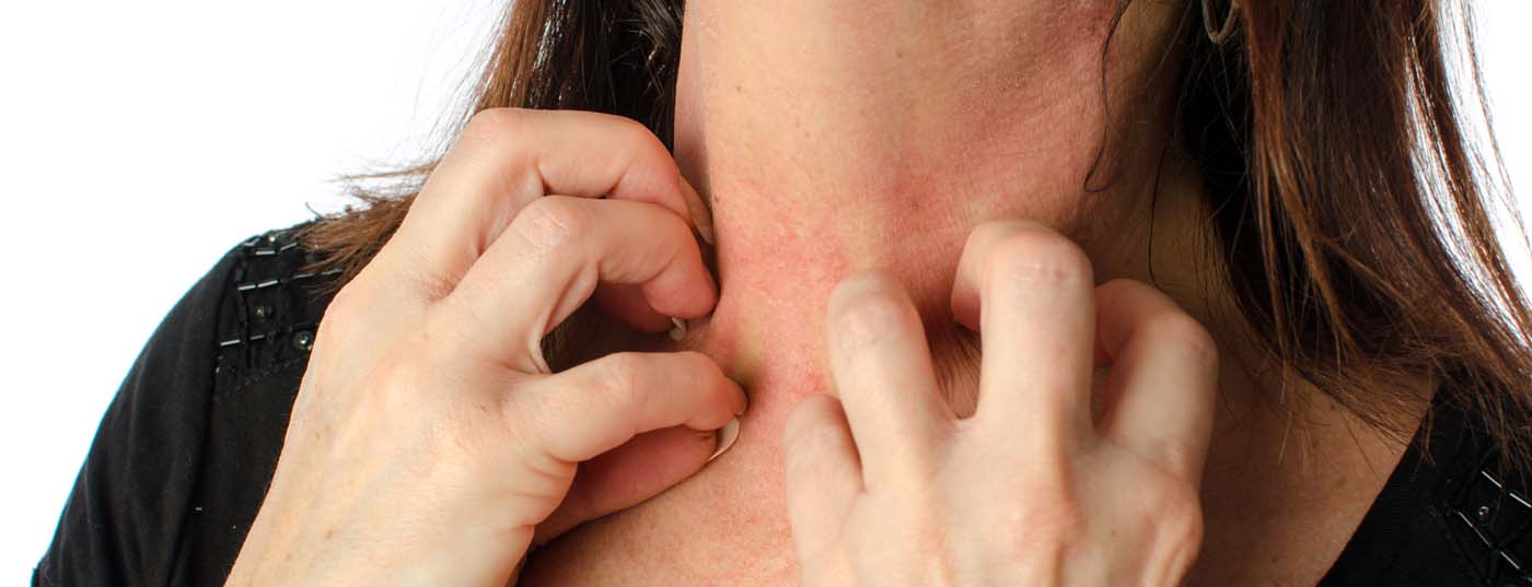head_dermatitis