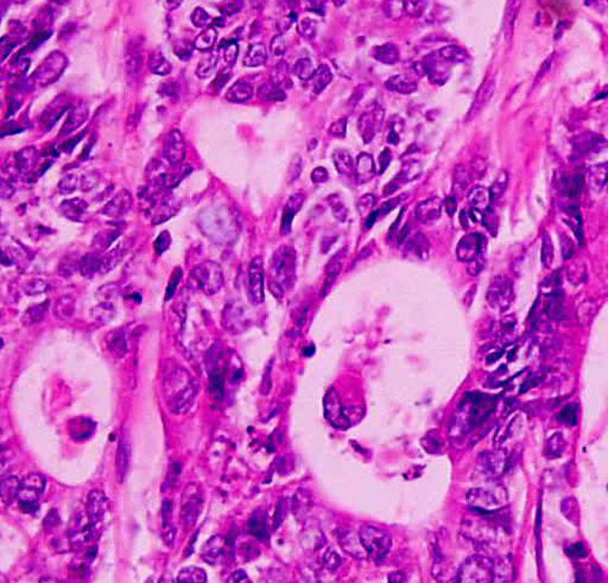 rektumkarzinom_wikipedia