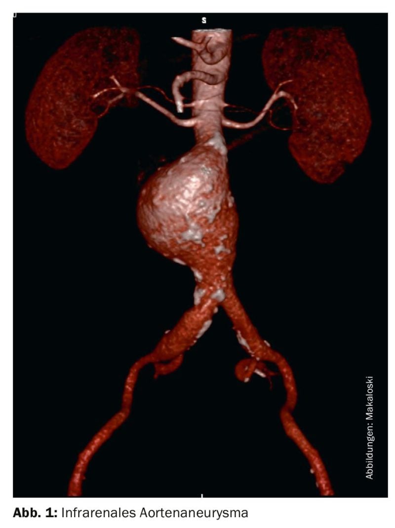 Tratamiento endovascular del aneurisma de aorta abdominal - Medizinonline