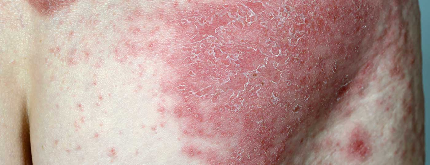 psoriasis2