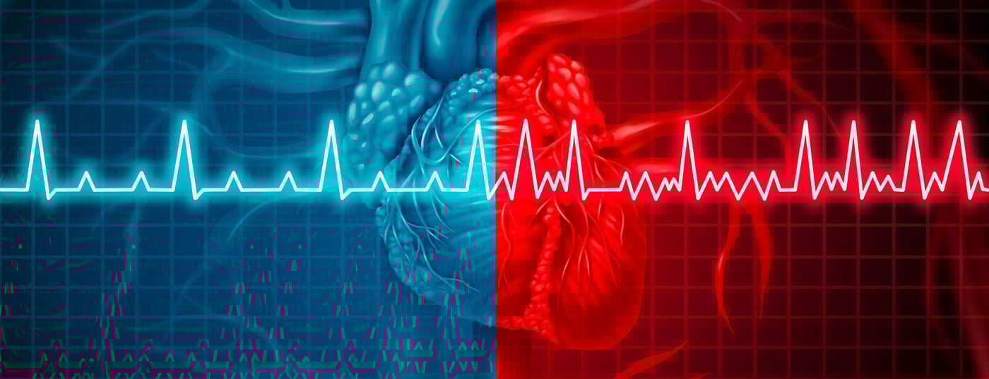 ekg_vorhofflimmern_istock-947331372