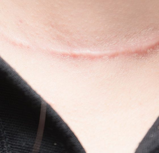 schilddruese_narbe_istock-930740678