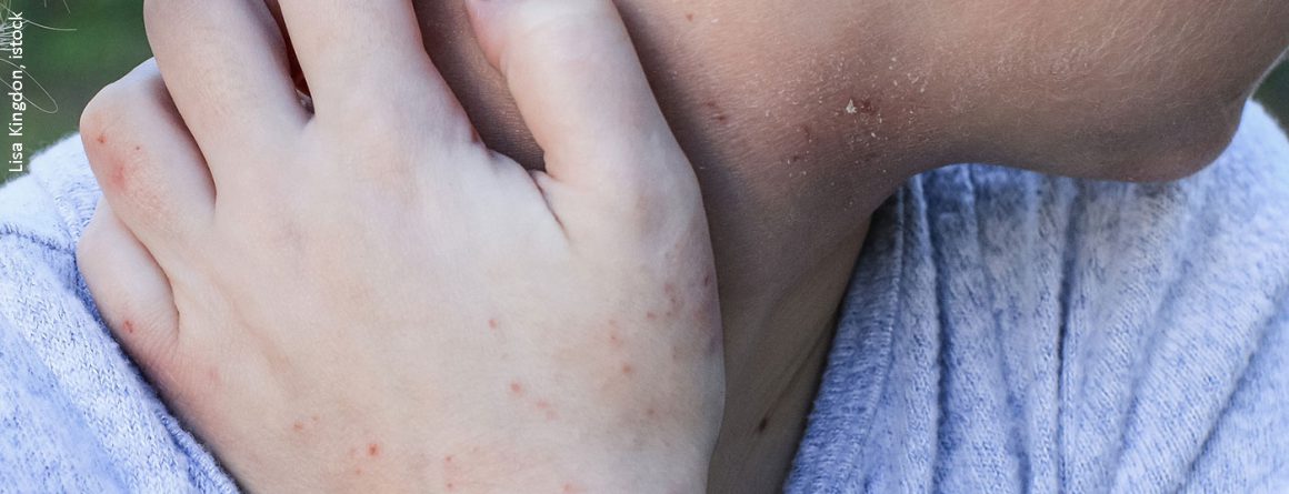 Topical calcineurin inhibitors Facts and myths