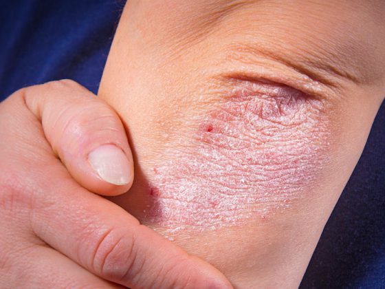 psoriasis_istock-510954994