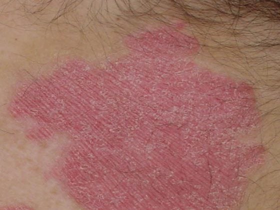 psoriasis_schuppenflechte