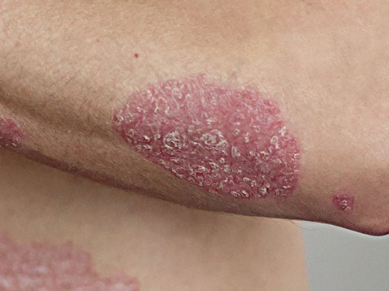 psoriasis_istock-1137585950