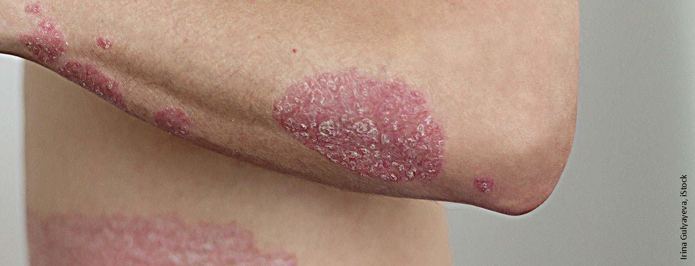 psoriasis_istock-1137585950