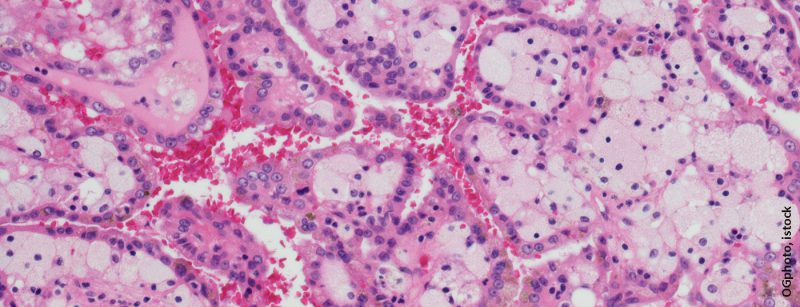 nierenzellkarzinom_istock-618736100