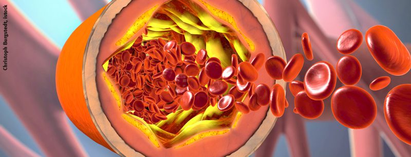 ader_atherosklerose_istock-875052952