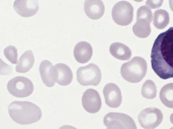 polycythemia_vera_blood_smear