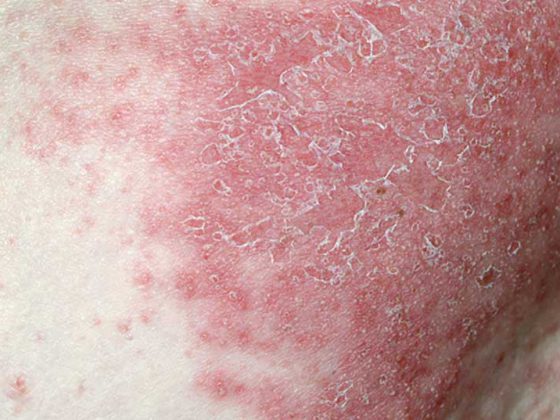 psoriasis2