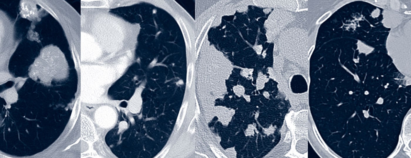 amyloidose_pulmonal