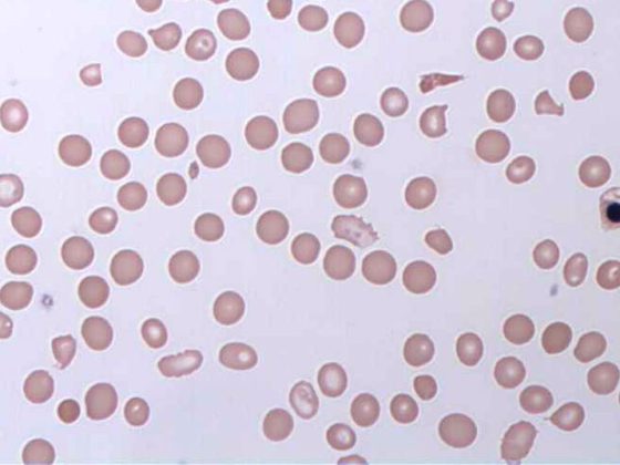 blutarmut_haemolytic_anaemia