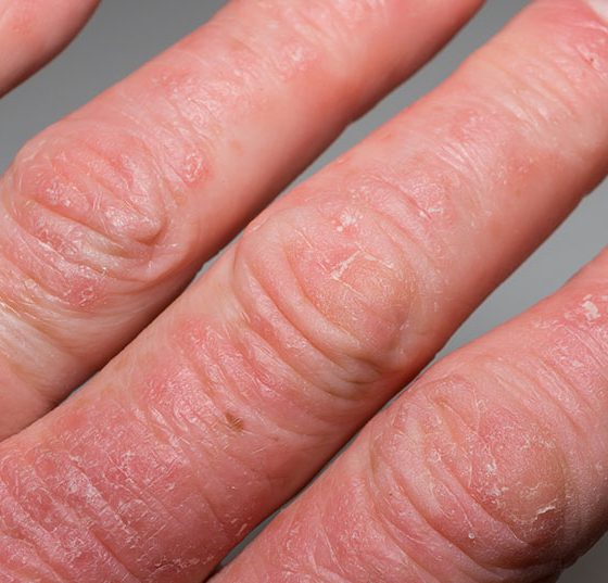 psoriasis-arthritis_istock-1176340885