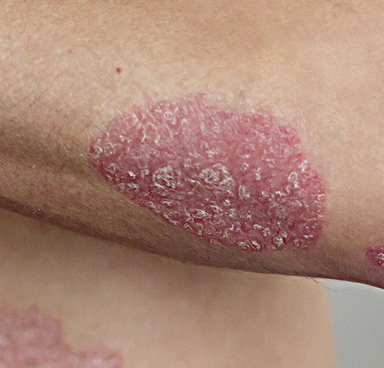 psoriasis_istock-1137585950