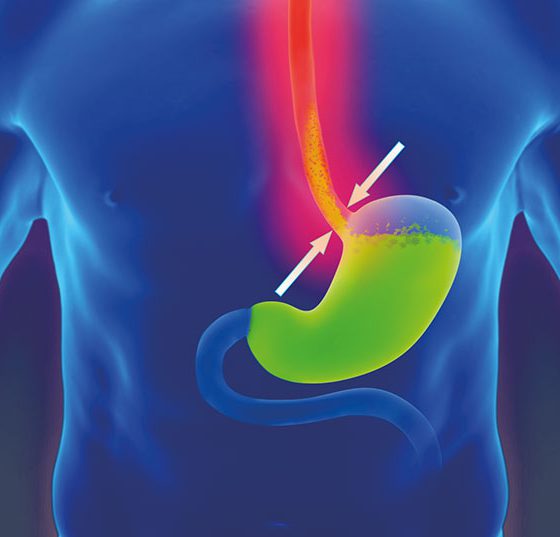 reflux
