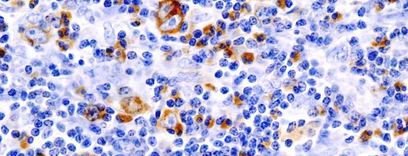 hodgkin_lymphoma