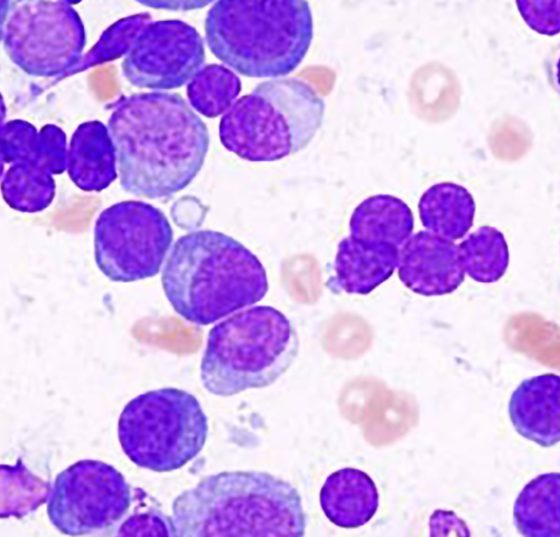 multiple_myeloma