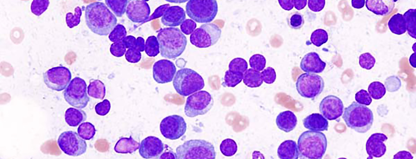 multiple_myeloma