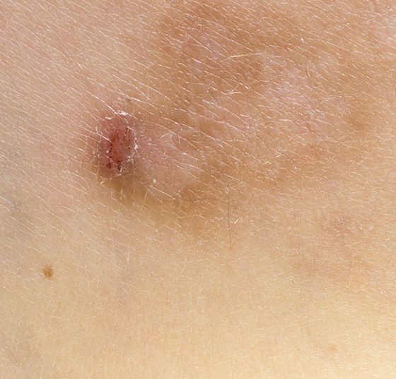 prurigo_istock-1203630687