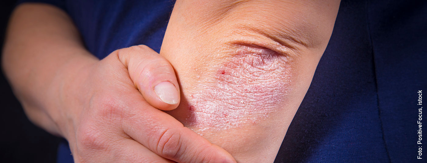 psoriasis_istock-510954994