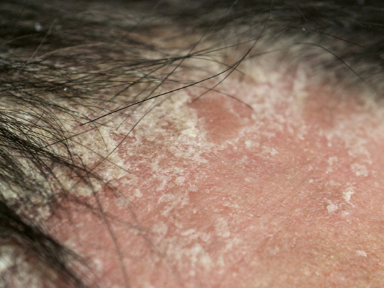 psoriasis_kopfhaut_istock-1127052066