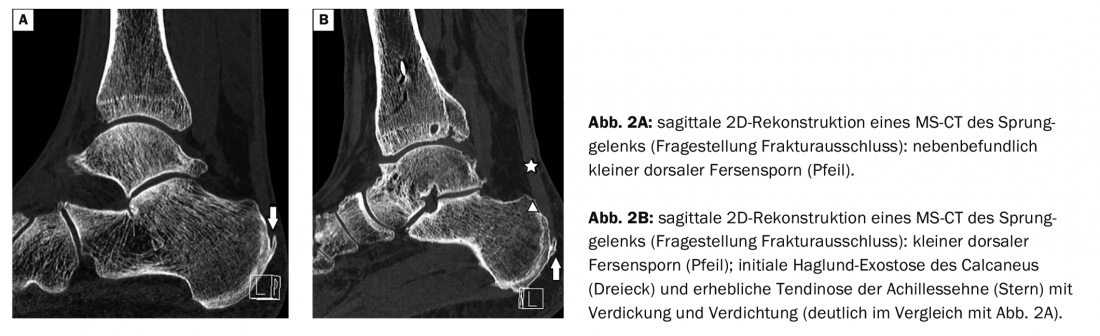 Joint diagnostics: dorsal heel pain - dorsal heel spur and