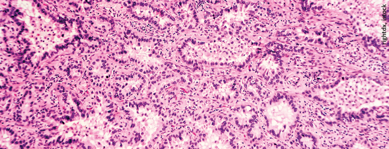 adenokarzinom_istock-531314236