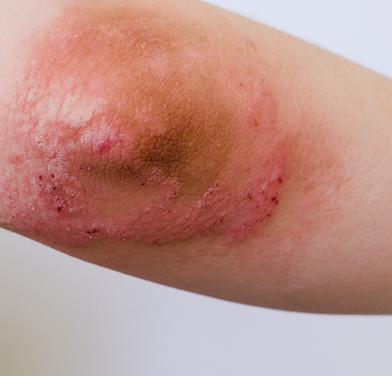 atop_dermatitis_istock-1248124105