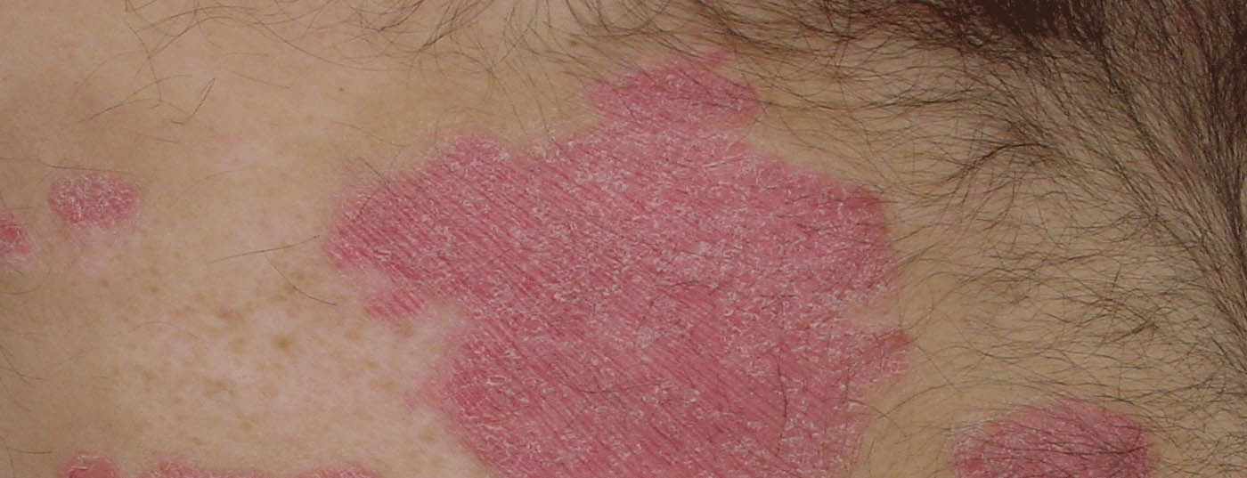 psoriasis_schuppenflechte