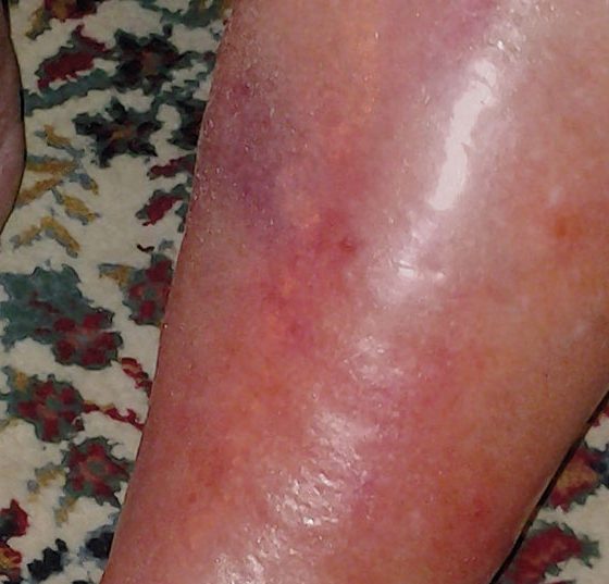 ersypel_istock-181147103