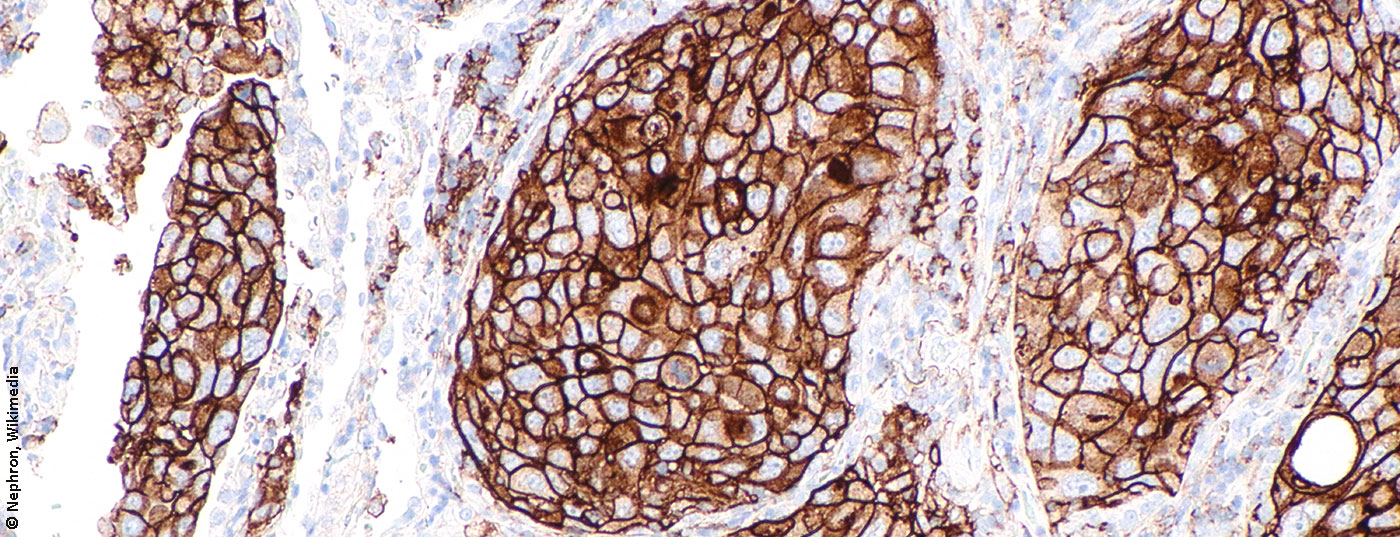 nsclc_lungenkrebs_nicht_kleinzellig