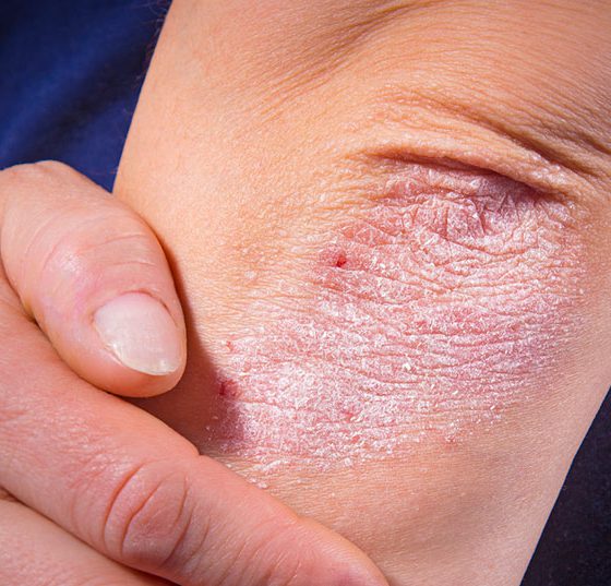 psoriasis_istock-510954994