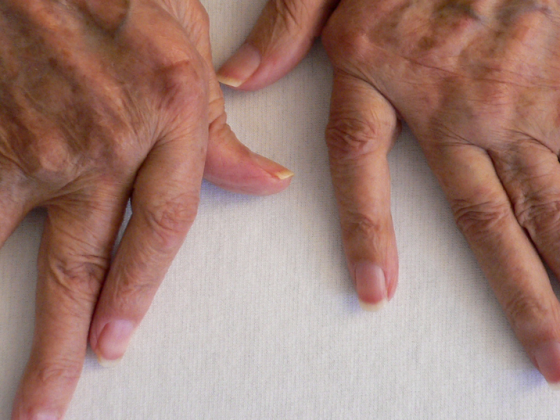 rheuma_arthritis_hand2