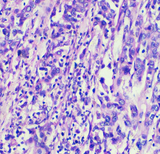 urothelkarzinom_istock