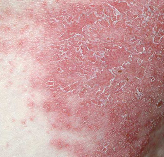 psoriasis2