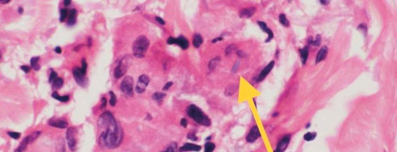 header_histopatho_elastophagozytose