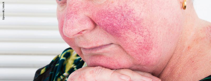 rosacea_istock-614739992