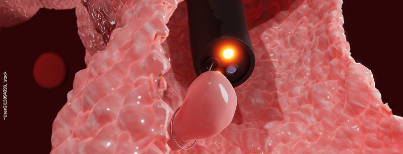 darmkrebs_koloskopie_istock-1322690771