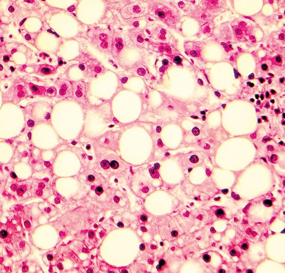 fettleber_istock-851075118