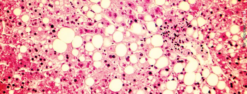 fettleber_istock-851075118