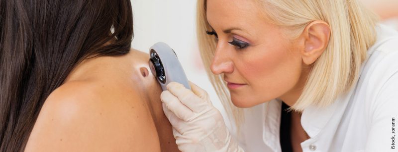 melanom_hautkrebs_485083156