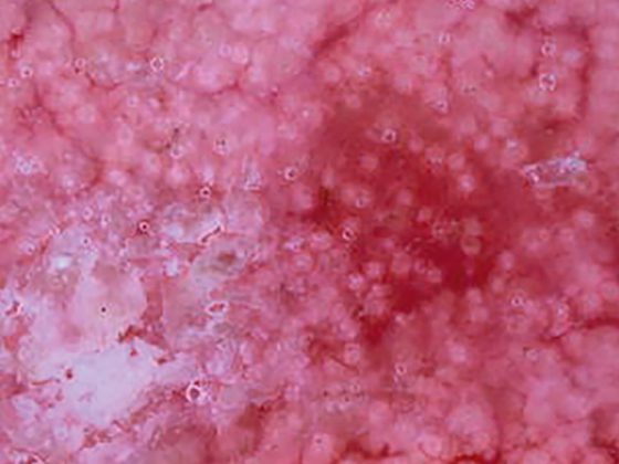 aktinischekeratose_wiki