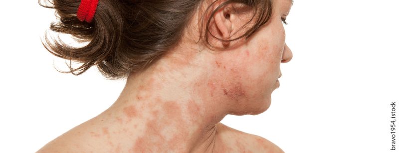 atopische_derma_istock-165665917
