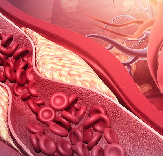 cholesterin_herz_istock-1293132839
