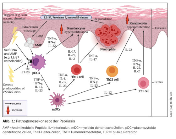Psoriasis - from immunopathogenesis to successful therapy - Medizinonline