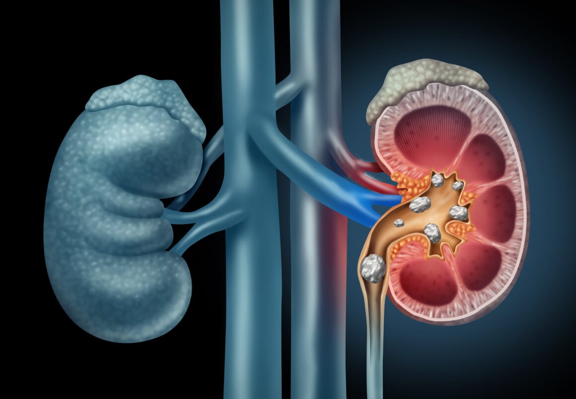 tirzepatide kidney stones reduces albuminuria among adults with type 2 diabetes in SURPASS trials Abdominal pain - Nephrolithiasis -